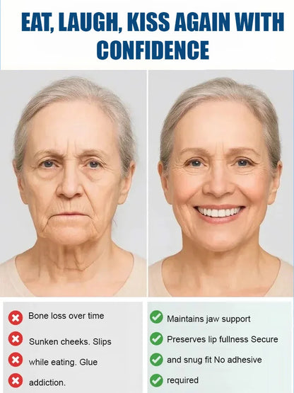 [Over 300,000 users worldwide] Full-mouth bone-supported denture set