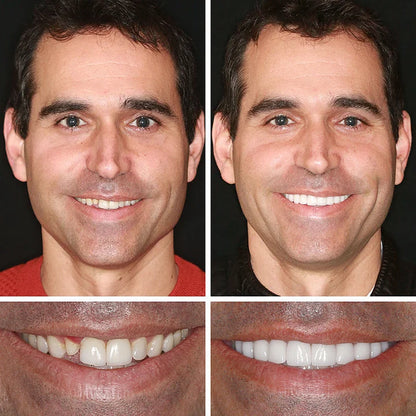 🔥Ends Today: 75% OFF! ⏰DarkFairy™ Medical Full Denture with Strong Suctiond Custom-Fit Full Functional Dentures🦷