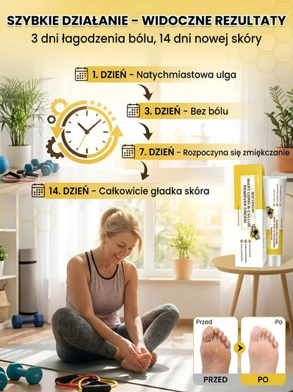 Bee venom cream for removing calluses and corns