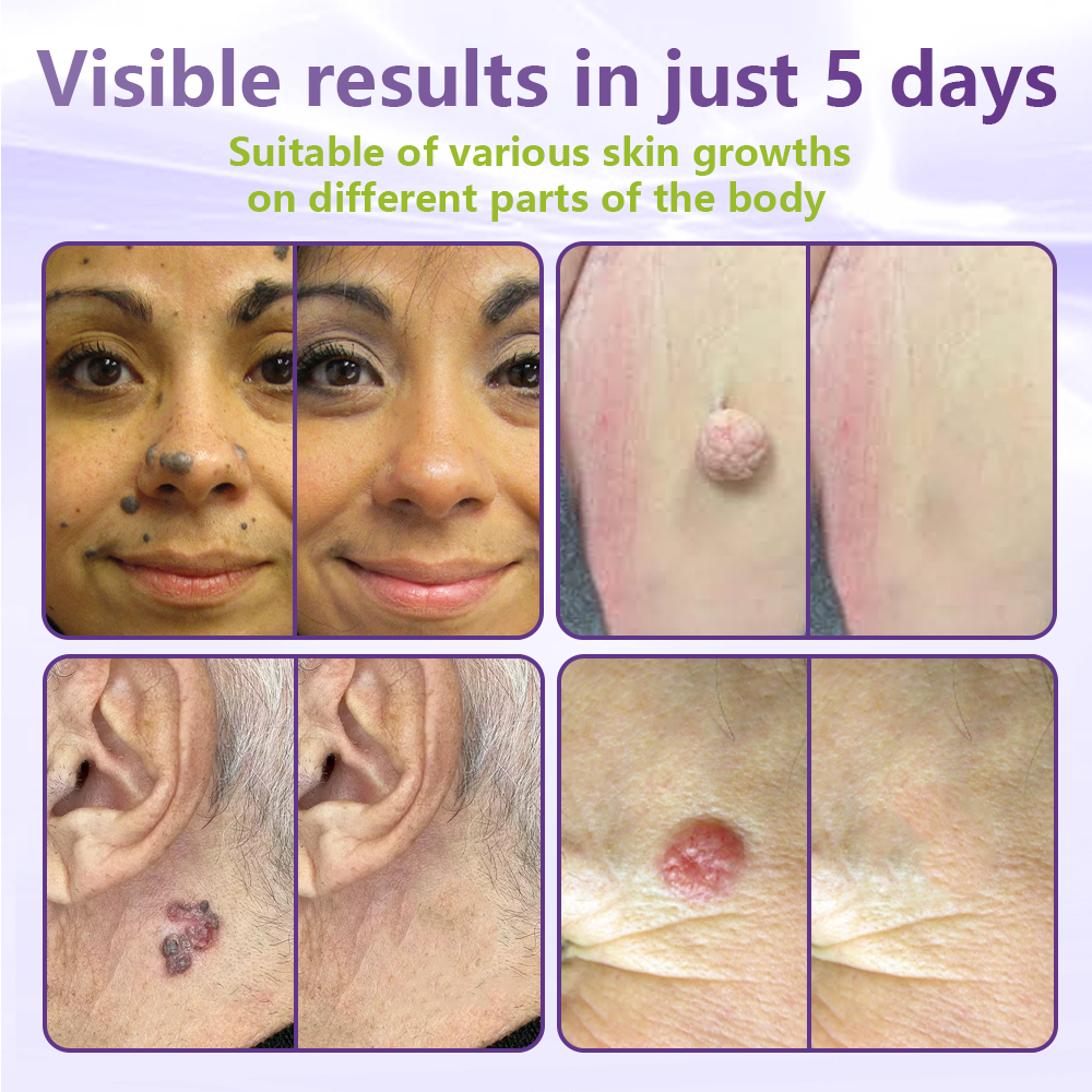 SOLUBLE MICRONEEDLE BOTANICAL SKIN TAG REMOVAL PATCH