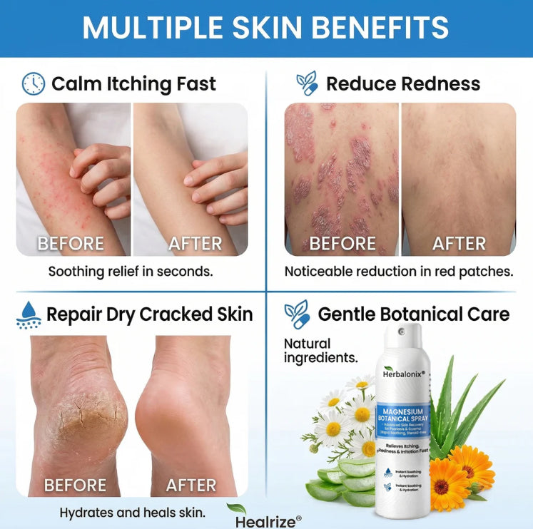 🔥Herbalonix® Magnesium Botanical Spray – Advanced Skin Recovery for Psoriasis & Eczema | Rapid Soothing, Steroid-Free