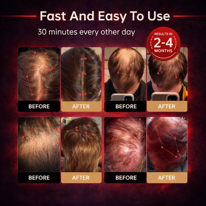 Torven Hair Regrowth Red Light Therapy