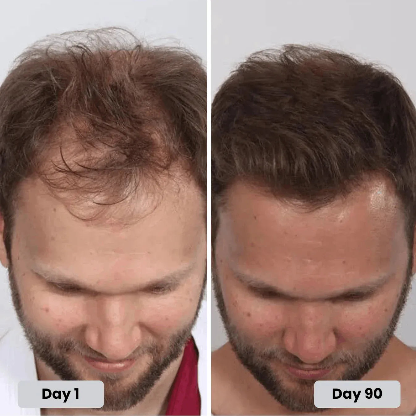Torven Hair Regrowth Red Light Therapy
