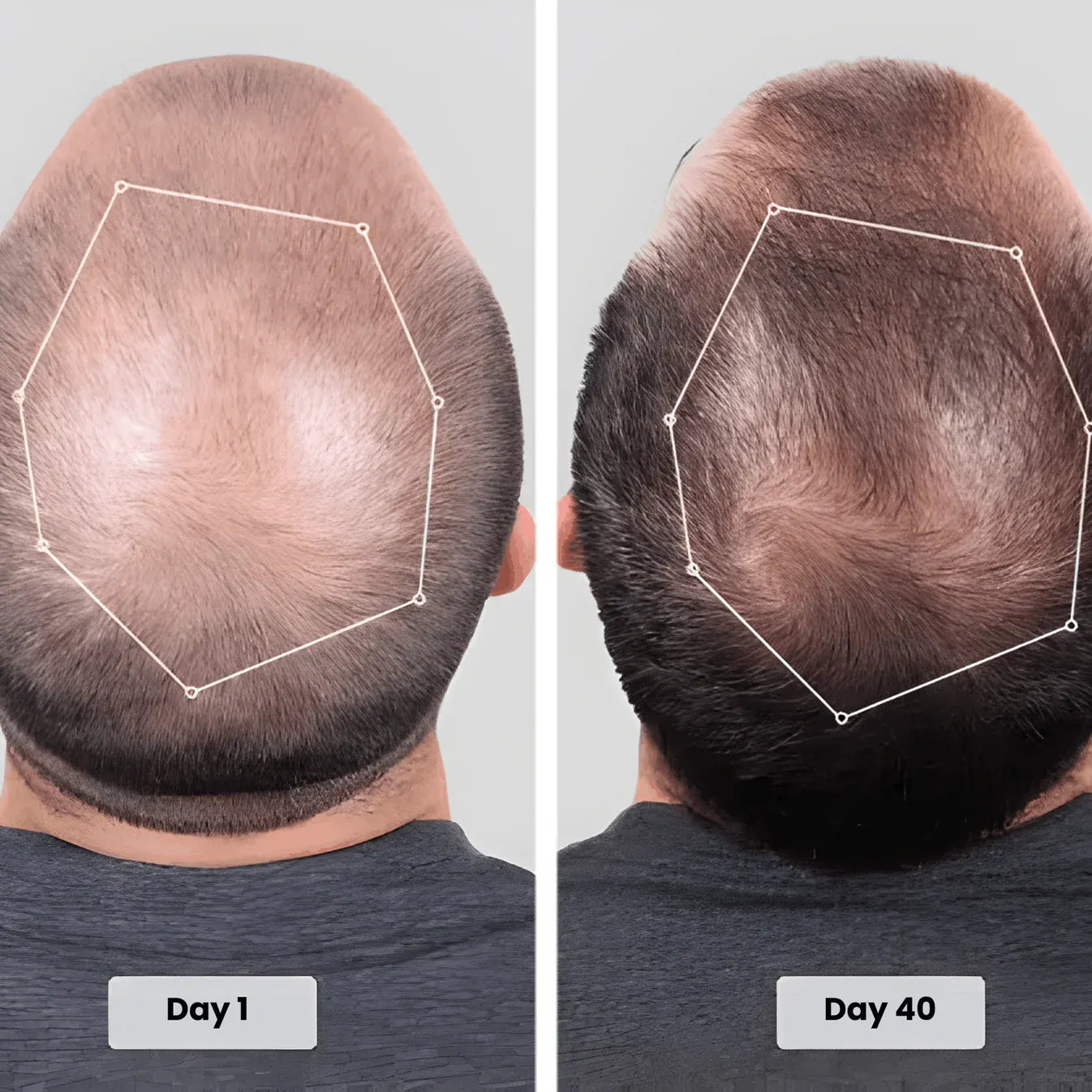 Torven Hair Regrowth Red Light Therapy